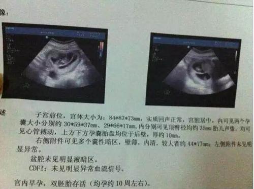 怀孕多久能看出单胞胎还是双胞胎